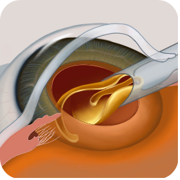 Phẫu thuật đục thuỷ tinh thể